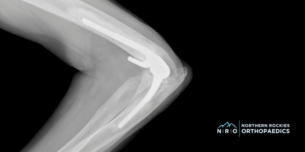 Elbow Pain Missoula, Montana