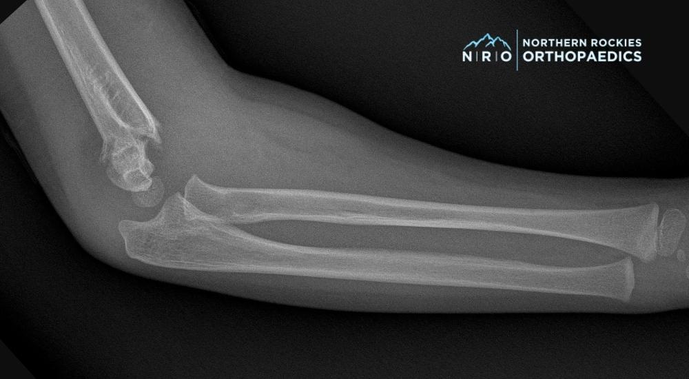 Elbow Surgeons in Missoula, Montana (2)