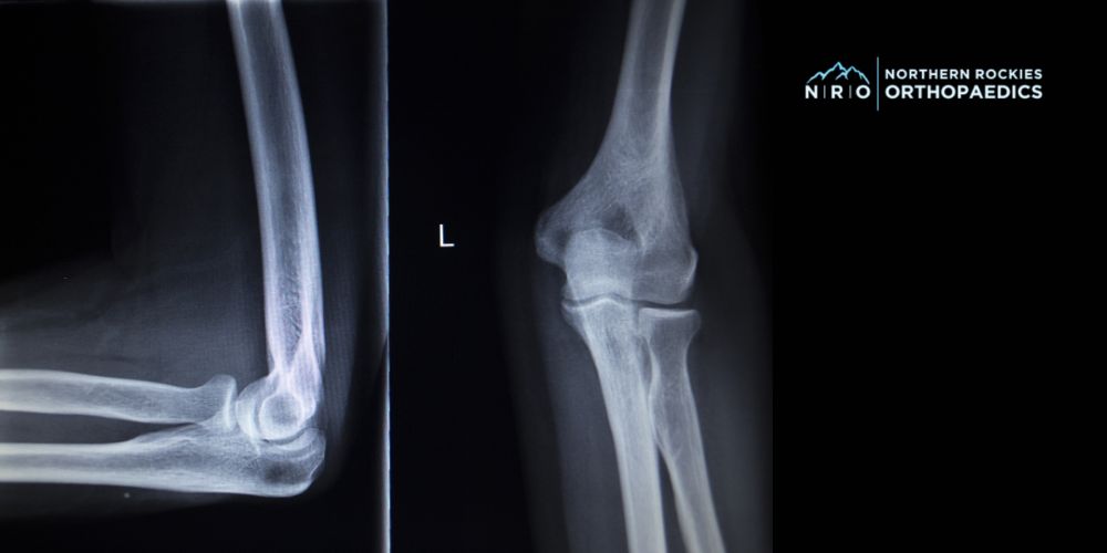 Elbow Surgery Missoula