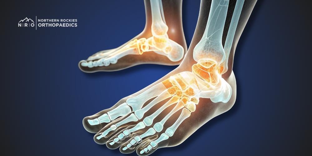 Foot and Ankle Arthritis Missoula, Montana