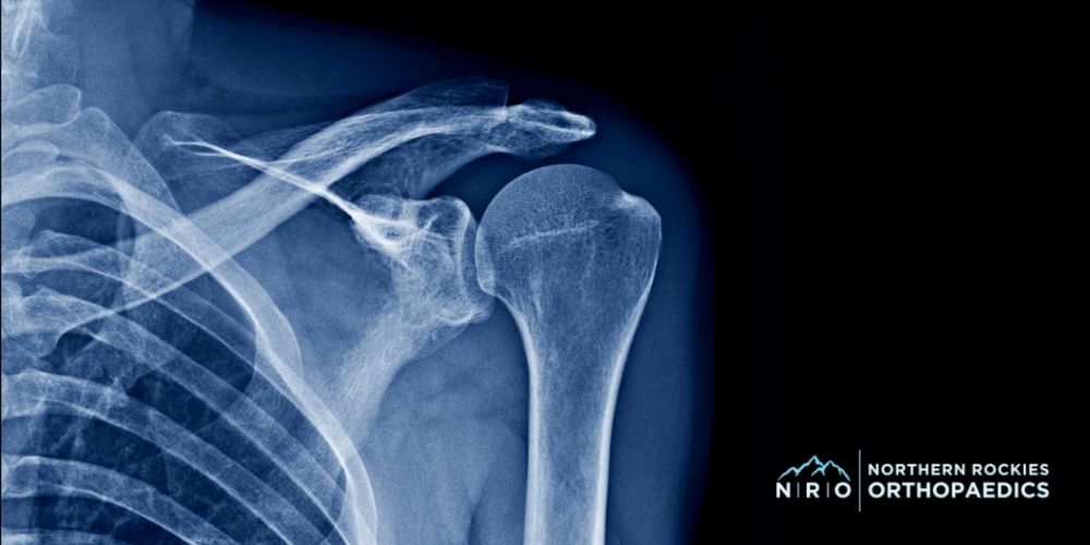 Missoula MT Shoulder Surgeon