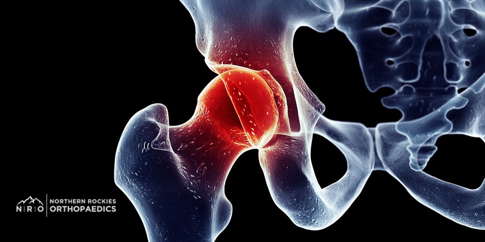 hip arthroscopy in missoula, montana