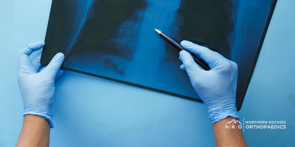 spinal fractures montana