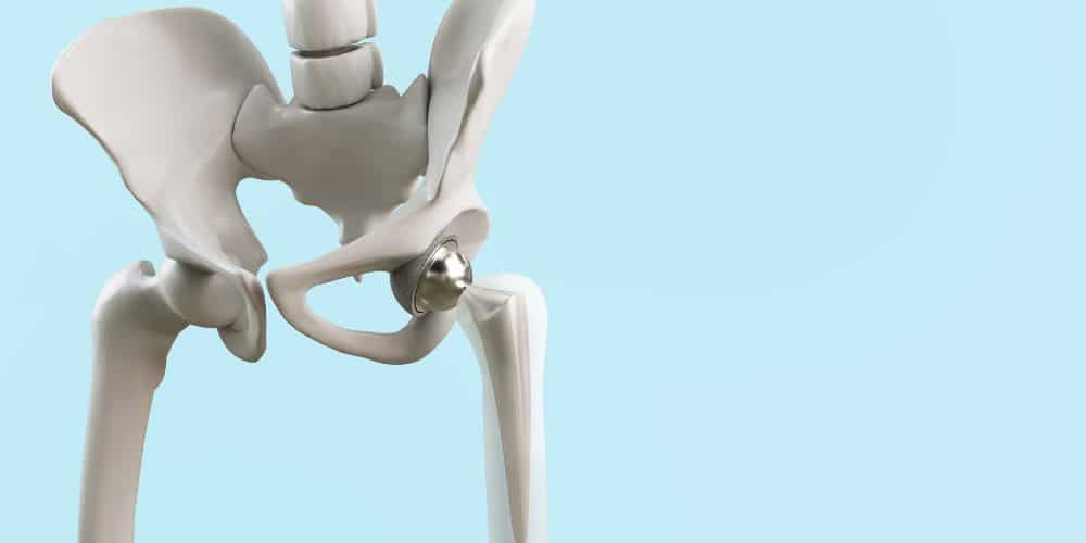 Missoula Hip Surgery